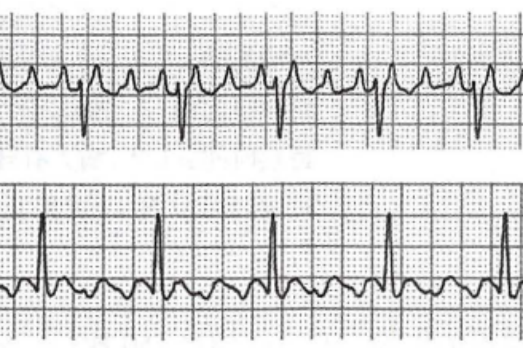 心房扑动心电图表现 心房扑动心电图表现