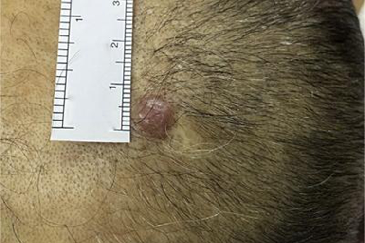 皮肤转移癌头皮症状图