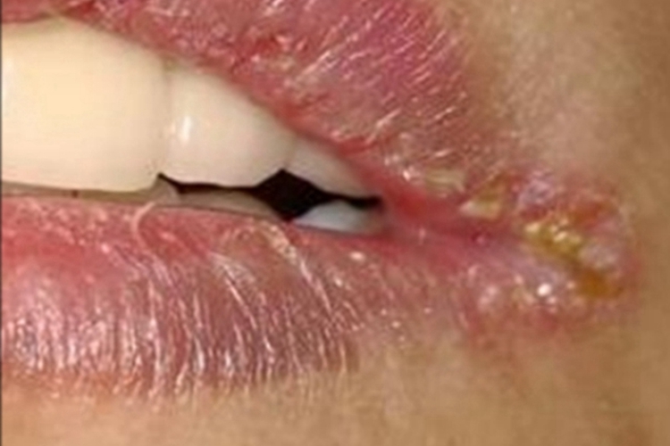 念珠菌性口角炎嘴唇皲裂图 念珠菌性口角炎嘴唇皲裂图