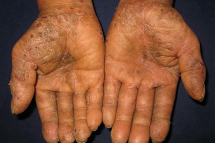 变应性接触性皮炎手掌症状图