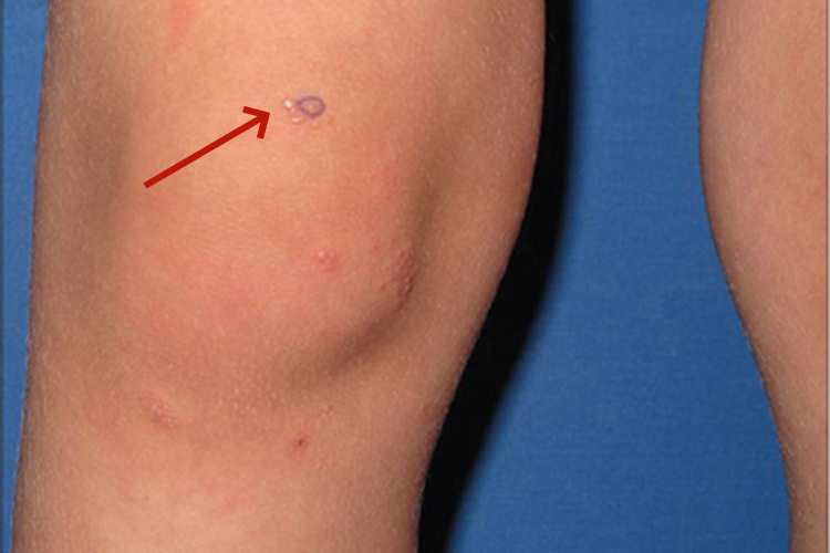 光泽苔藓膝盖症状图