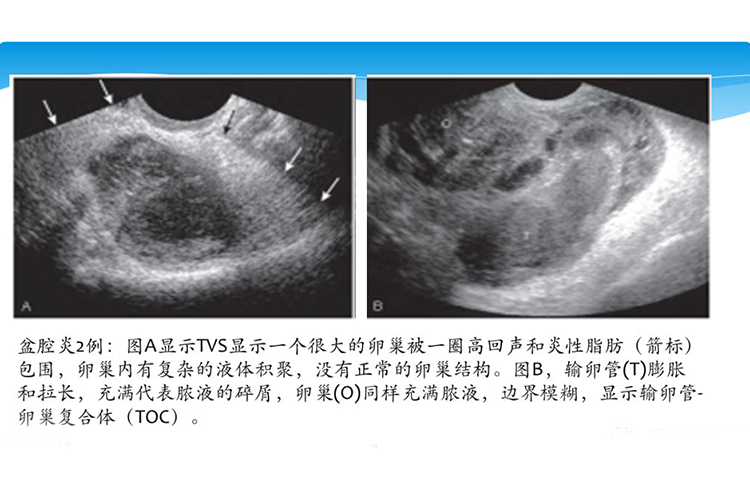 盆腔炎超声图