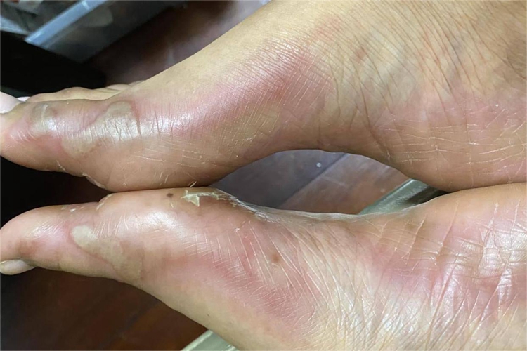 手足综合征脚部症状图