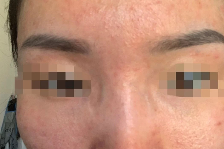 接触性皮炎红痘痘图