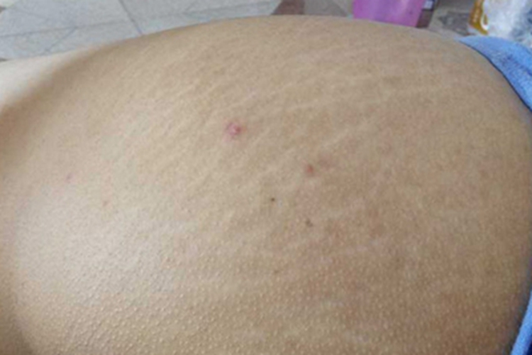 妊娠纹臀部症状图 妊娠纹臀部症状图