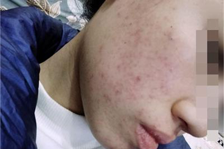 痤疮面部疙瘩和斑点图