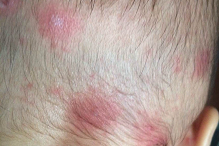 新生儿脓疱疮头皮红斑图