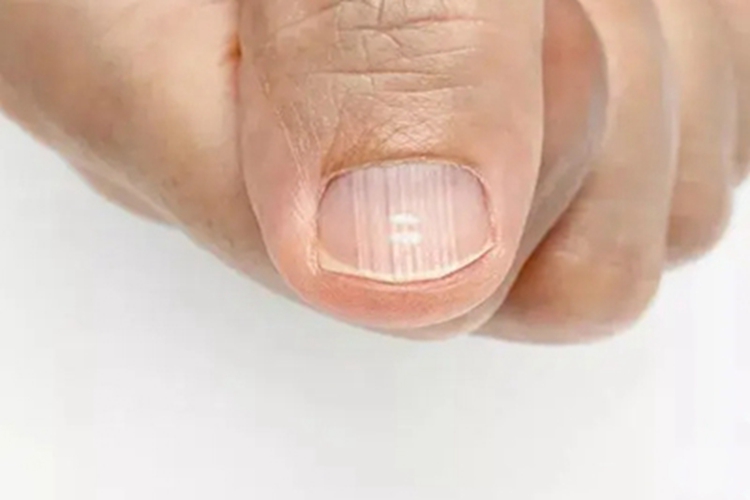 甲营养不良手指甲竖纹图 甲营养不良手指甲竖纹图