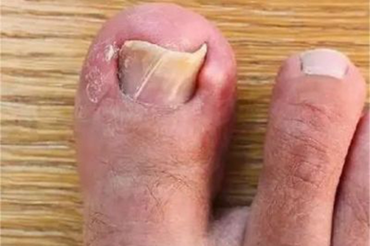 慢性甲沟炎脚趾甲发黄变厚图