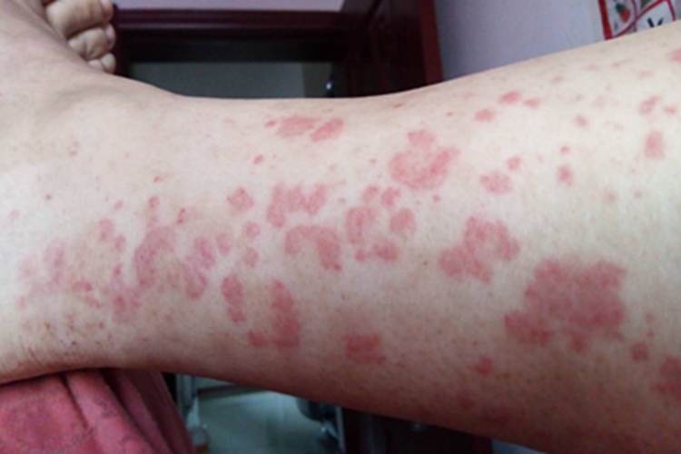 皮肤小血管炎小腿红斑图 皮肤小血管炎小腿红斑图