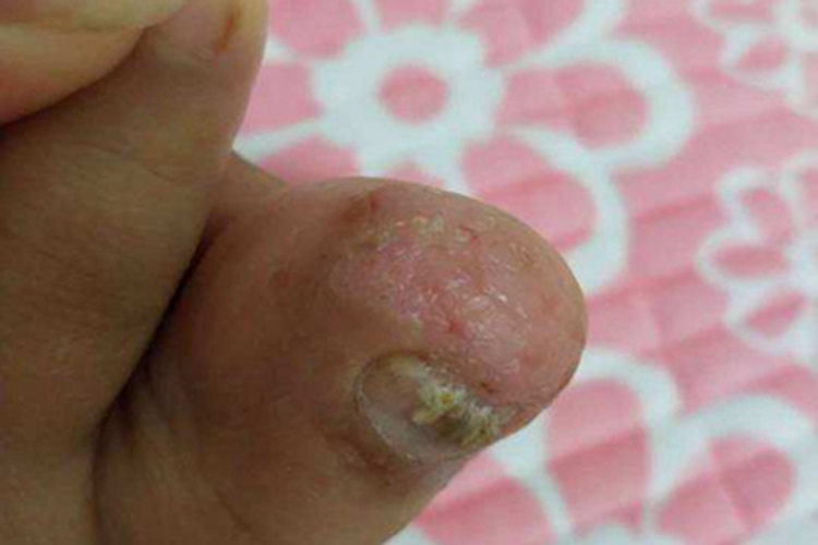 脚趾长水疱破了糜烂图