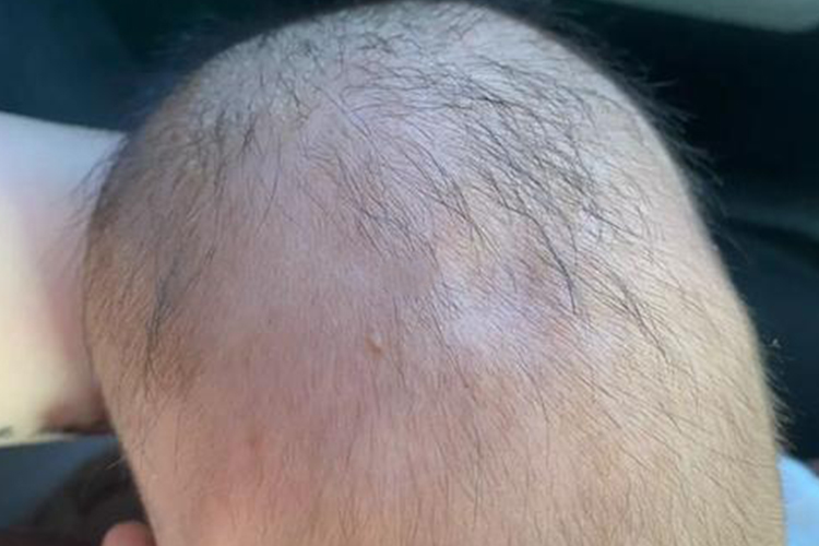 婴儿前囟门轻微凹陷图 婴儿前囟门轻微凹陷图