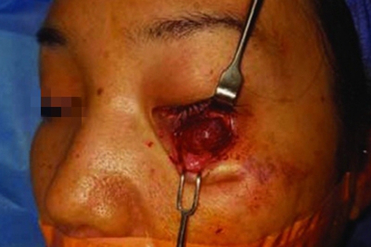 眼眶海绵状血管瘤眼周症状图