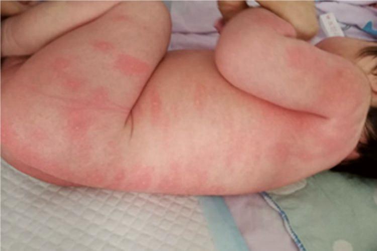 多形红斑全身红斑图 多形红斑全身红斑图