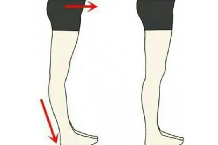 膝过伸和正常腿对比图