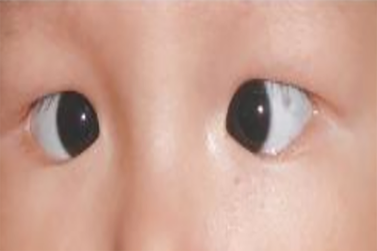 斜视黑眼珠不对称图 斜视黑眼珠不对称图