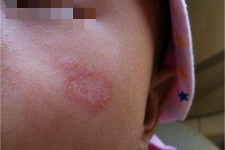 儿童银屑病红斑图