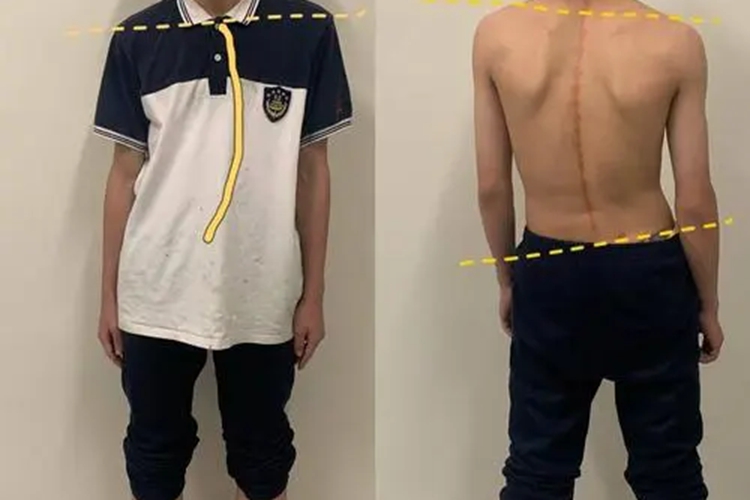 男孩左右肩膀不对等图