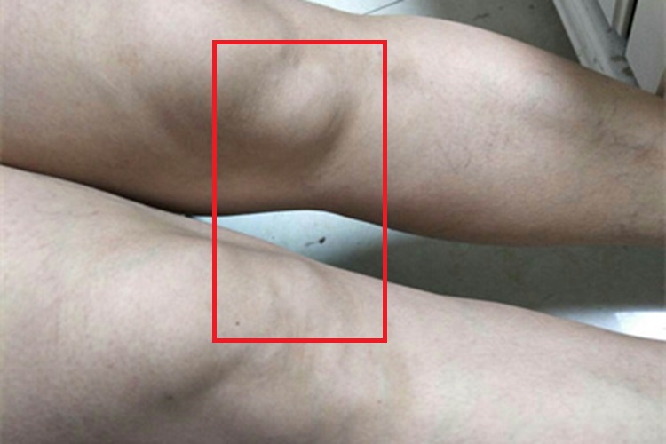 转移性皮肤钙沉着症膝盖症状图