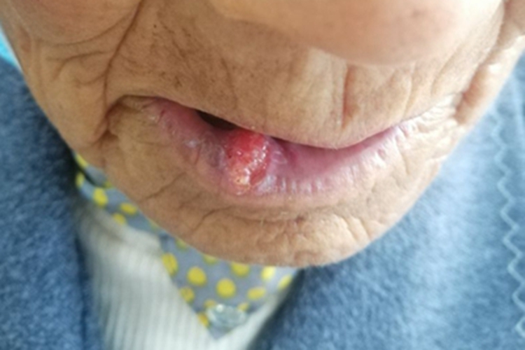 唇癌疙瘩图 唇癌疙瘩图