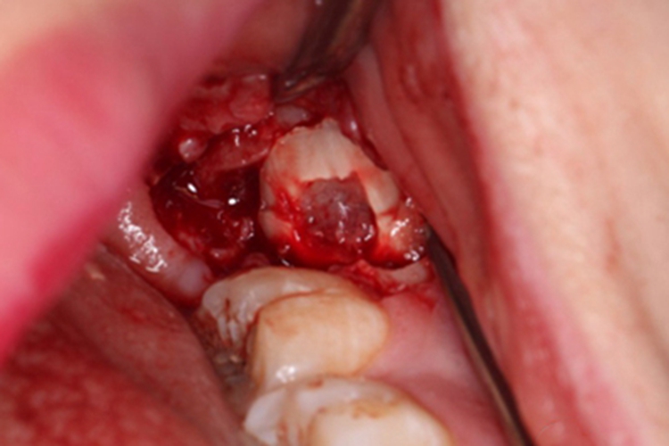 拔除阻生牙的牙根图