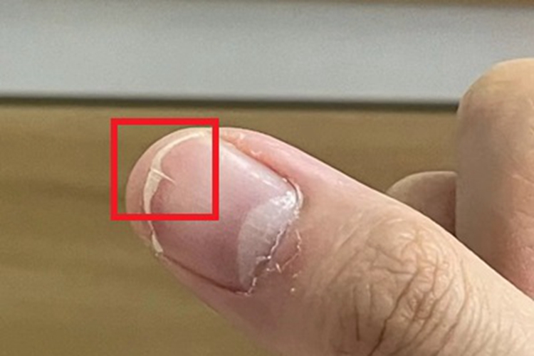 甲纵裂大拇指有小裂口图