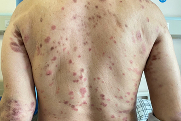 大疱性后背散在红斑图
