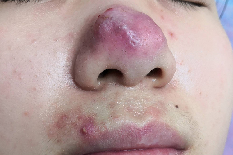 玫瑰痤疮严重图 玫瑰痤疮严重图