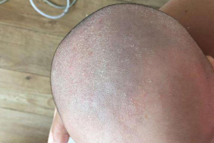 2个月宝宝白色片状头皮屑图 2个月宝宝白色片状头皮屑图