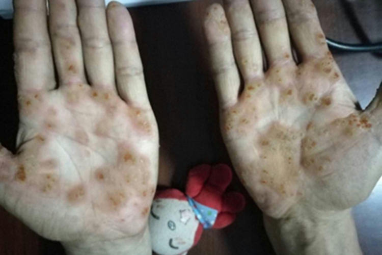 点状掌跖角化病手部症状图