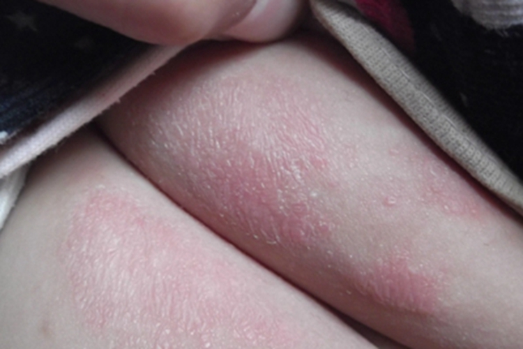 肛门瘙痒症臀部症状图