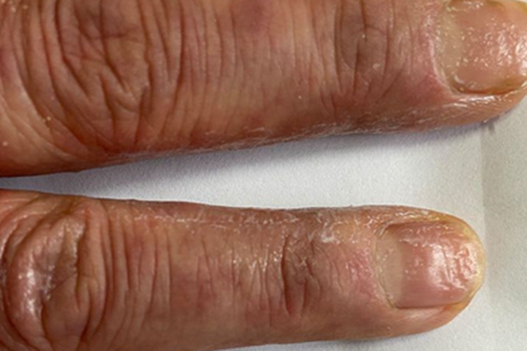 银屑病关节炎手指甲症状图