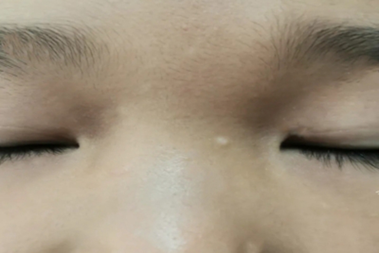 孤立性毛发上皮瘤症状图 孤立性毛发上皮瘤症状图