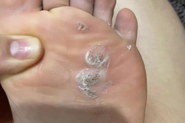 寻常疣脚底血痂图