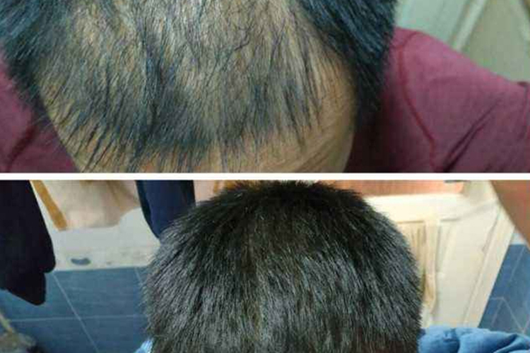 吃非那雄胺片一年效果图 吃非那雄胺片一年效果图