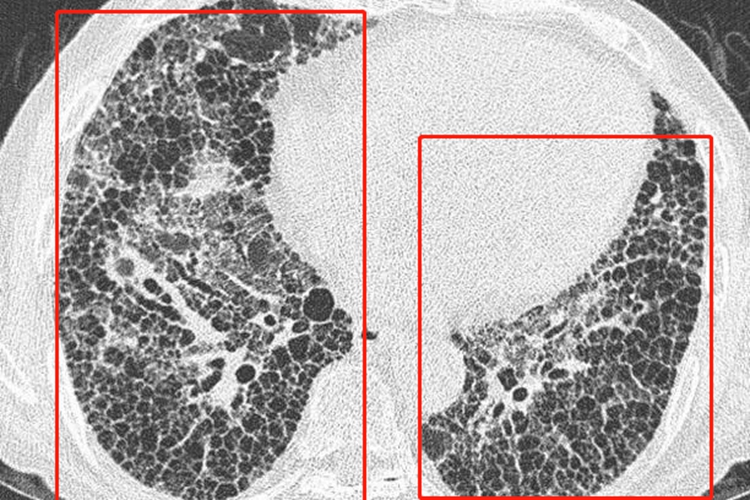 肺间质纤维化图