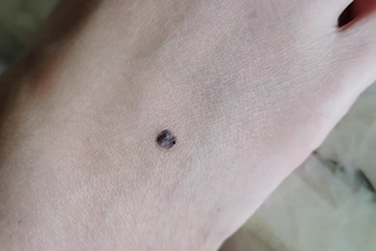皮内痣脚背结节图 皮内痣脚背结节图