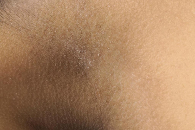 假性黑棘皮病颈部黑像鸡皮图