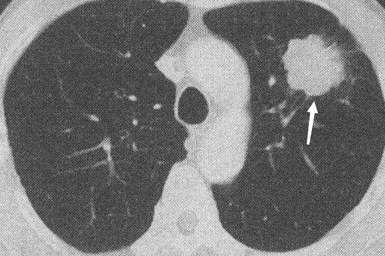 周围型肺癌CT图