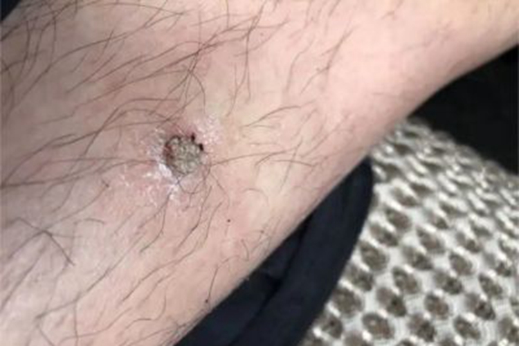 寻常疣腿部硬疙瘩图 寻常疣腿部硬疙瘩图