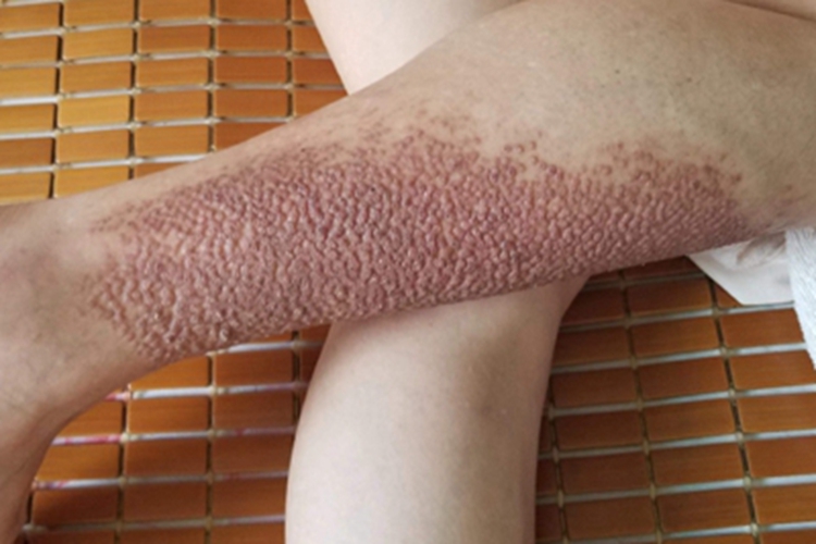 苔藓样念珠状疹丘疹图