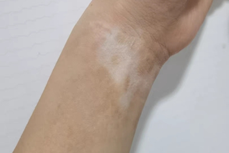 非节段型白癜风手腕症状图