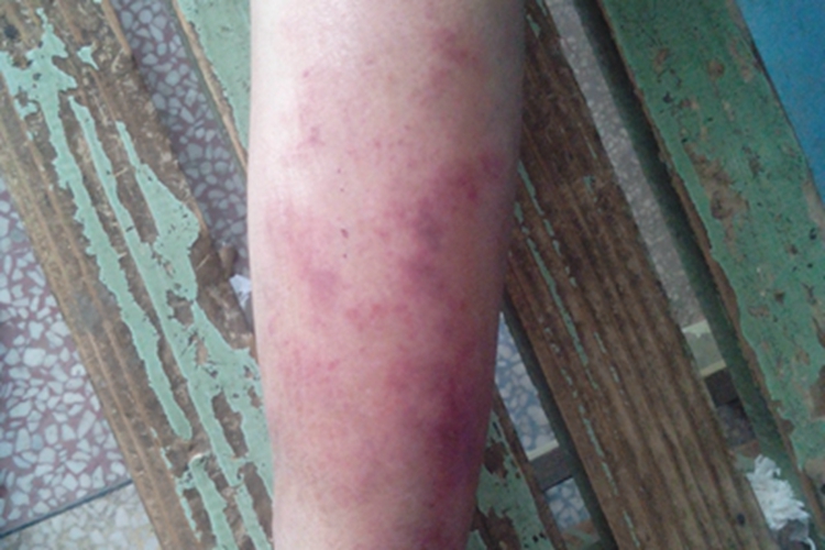 急性期皮肤丝虫病小腿红斑图