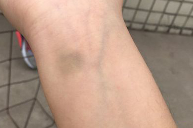 单纯性紫癜手腕内侧淤青图 单纯性紫癜手腕内侧淤青图