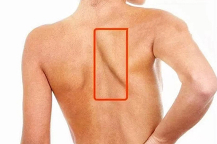 锁骨骨折畸形愈合伪翼状肩胛骨图