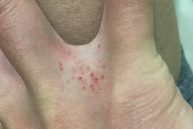 手指间擦疹图 手指间擦疹图