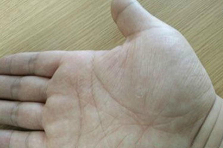 缺铁性贫血手掌苍白图