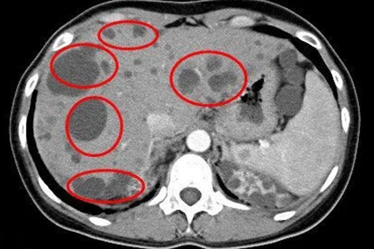 肝囊肿影像图