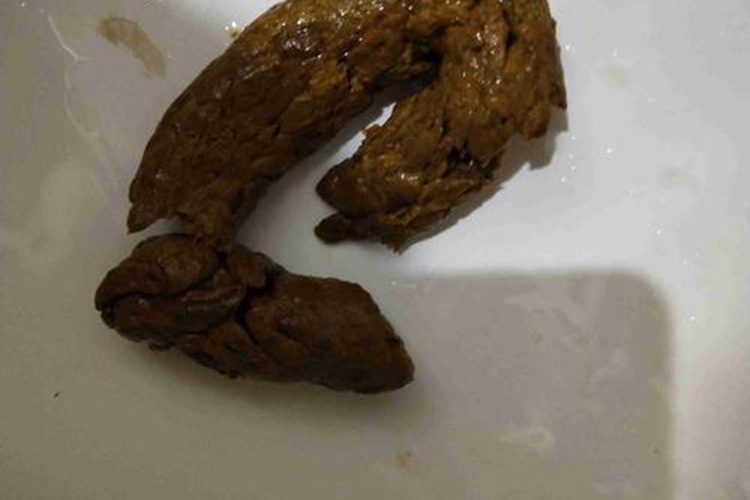 一岁宝宝混合喂养大便图