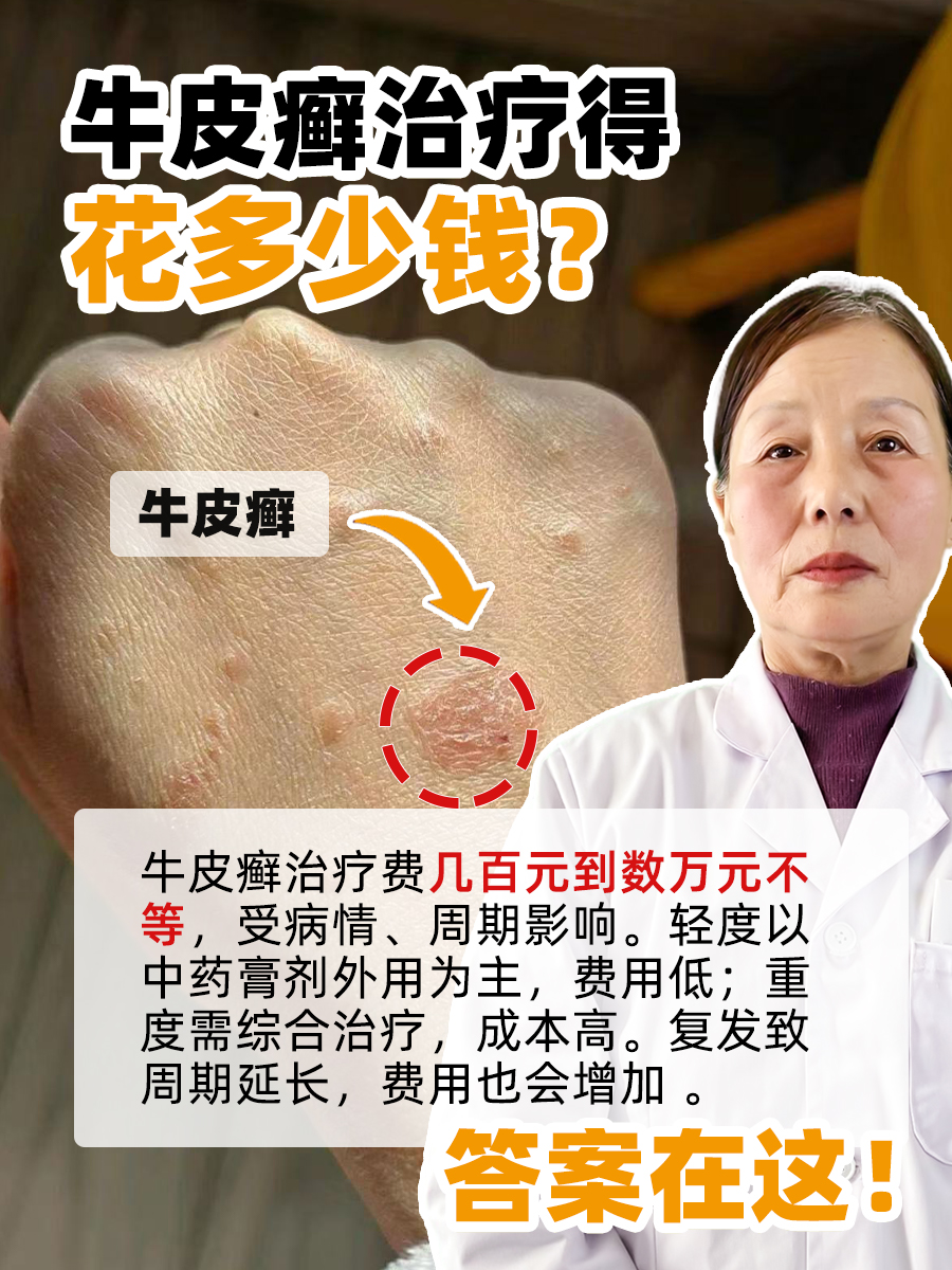 牛皮癣治疗得花多少钱？答案在这！